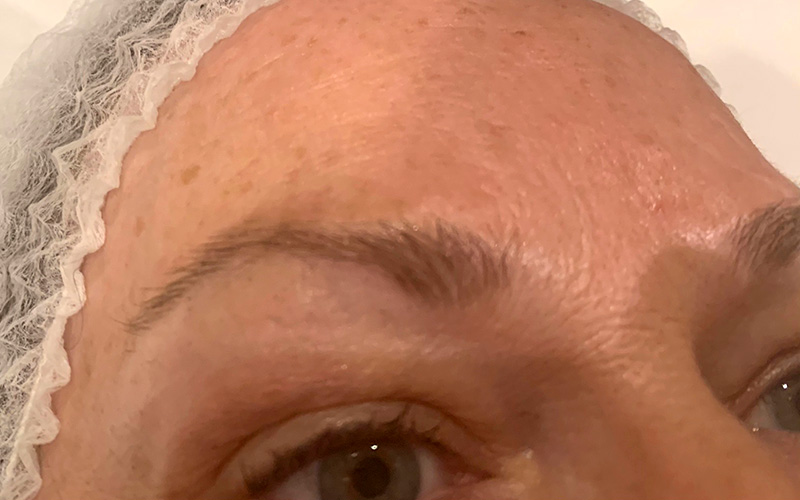 Micropigmentation - Before